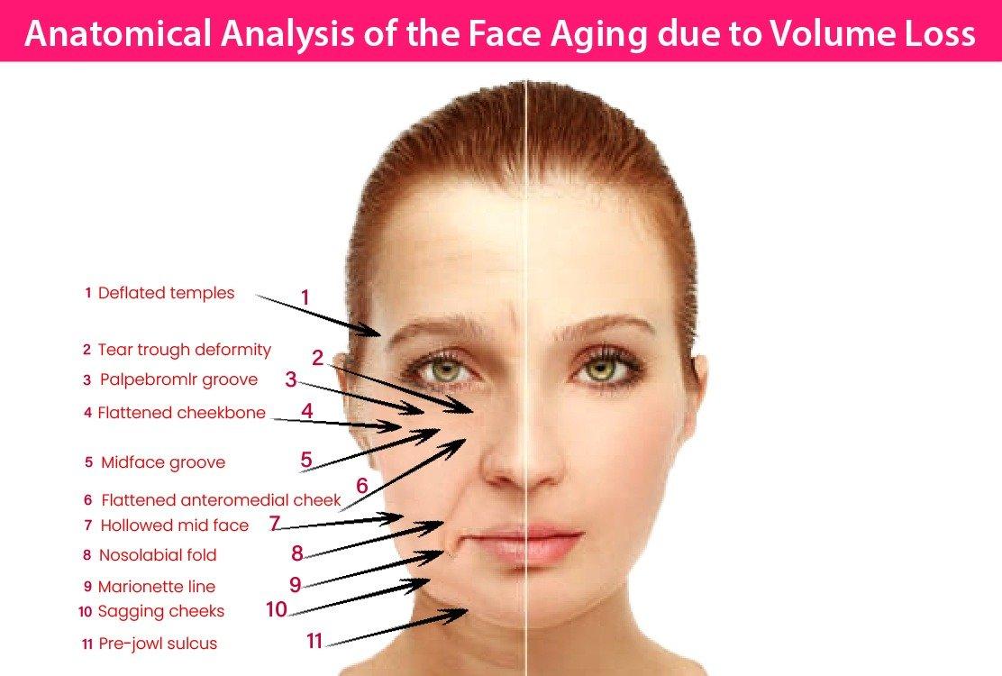 Where is Sculptra injected?